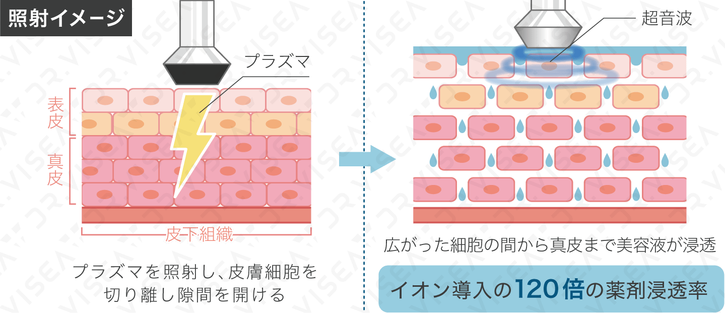 プラズマ×超音波の高浸透導入イメージ|フェイシャルエステ 岡谷市