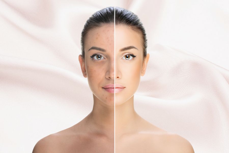 プラズマ施術のビフォーアフターで肌悩みが改善|フェイシャルエステ 岡谷市