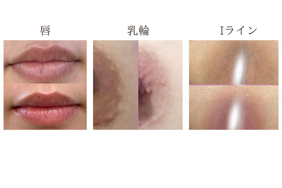 ローマピンクの美白効果と持続イメージ|ローマピンク 岡谷市