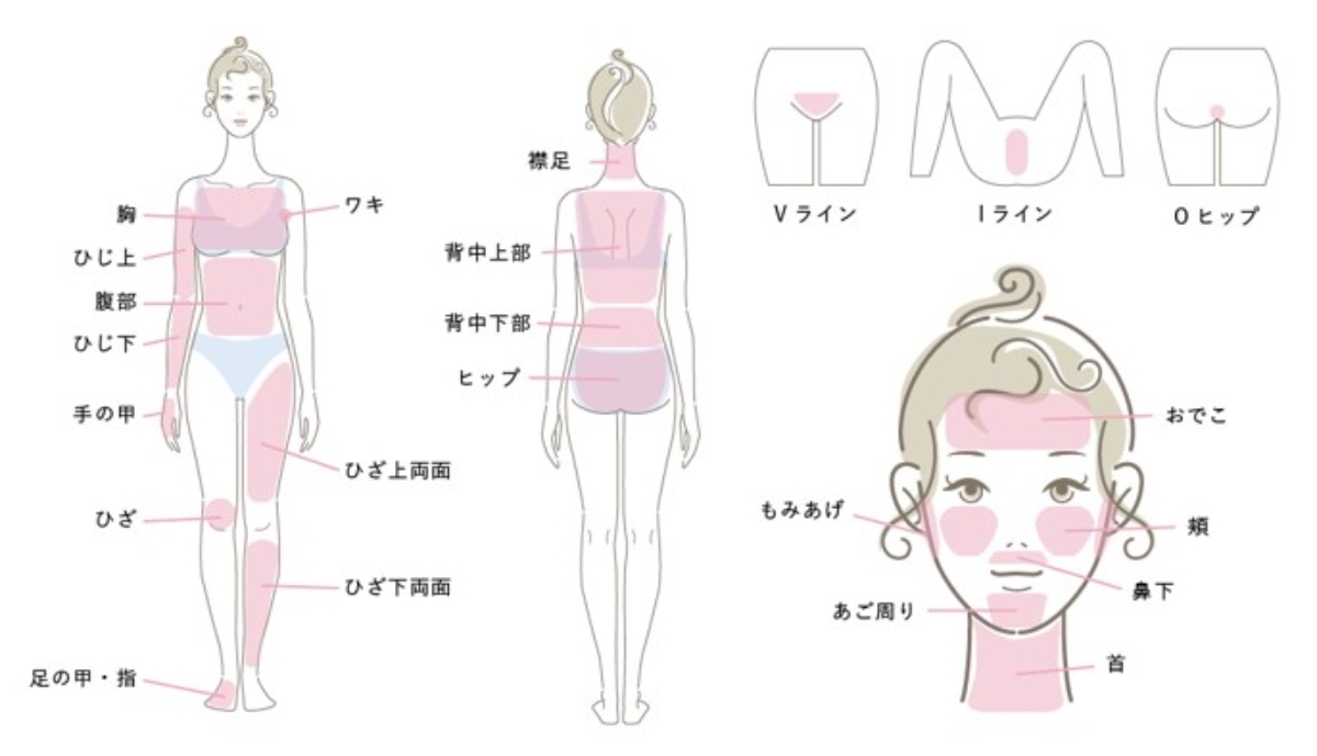 岡谷市のメンズエステで行える脱毛パーツの解説図